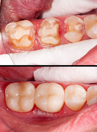 Dental Fillings Short Hills