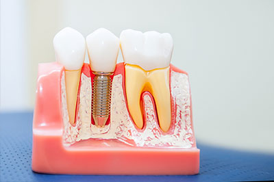 Dental Implants in Short Hills