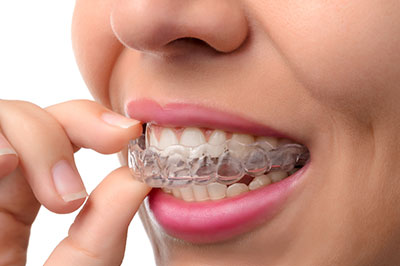 Invisalign Millburn NJ