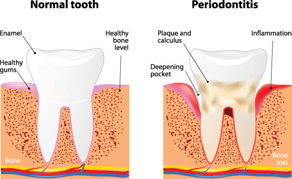 Periodontal Dental Treatment in Short Hills