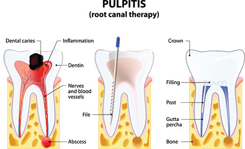 Root Canal Treatment in Short Hills