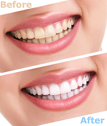 Short Hills Teeth Whitening